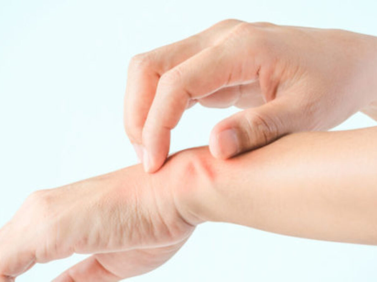 Unter einer Allergie (Überempfindlichkeit) versteht man eine Überreaktion des Immunsystems. Diese können sich sehr vielseitig an der Haut äußern z.B. mit Juckreiz, Rötungen und Schwellungen bis hin zu systemischen Reaktionen wie Atemnot und Kreislaufproblemen.