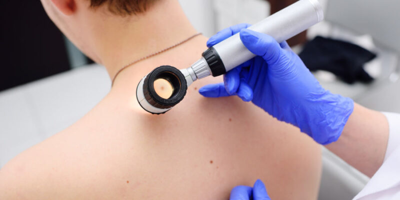 Die Prävention und die Früherkennung von Hautkrebs ein Schwerpunkt in unserer dermatologischen Praxis.